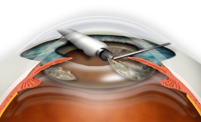 The replacement of refraction of the objective is carried out via microndle, which excludes blood loss