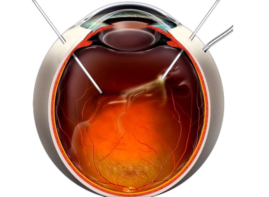 Vitrelctomy - A procedure shown to people during the exfoliation of the retina